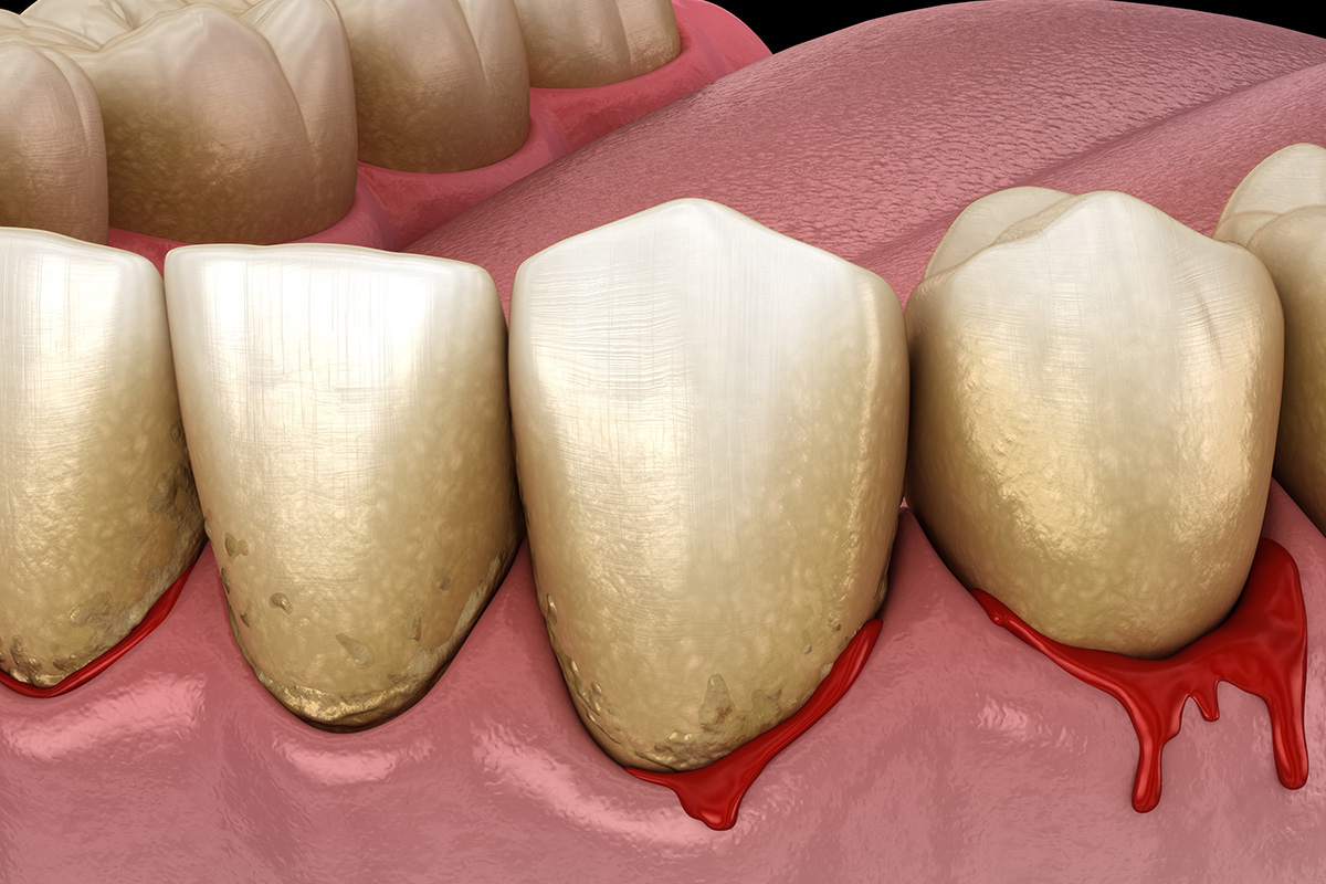 Bleeding Gums Something to Worry About