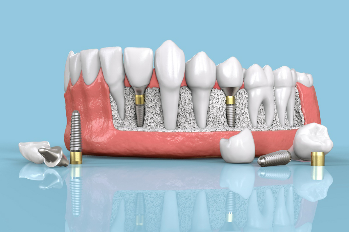 Dental Implants How They Integrate With Jawbone