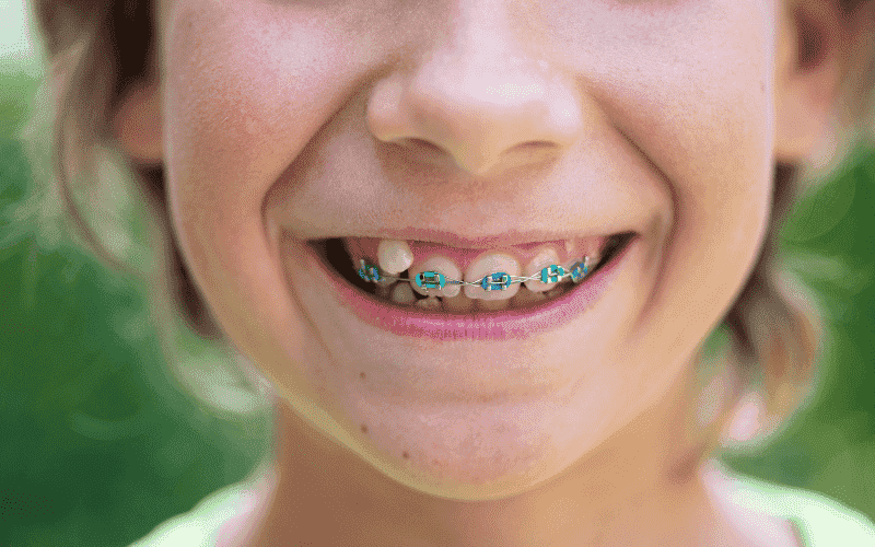 When To Start Orthodontic Treatment For Your Child