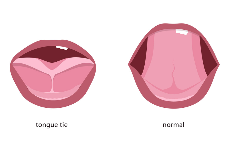 Signs & Symptoms of Lip and Tongue-Tie