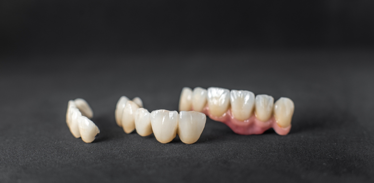 How many types of dental crowns are there